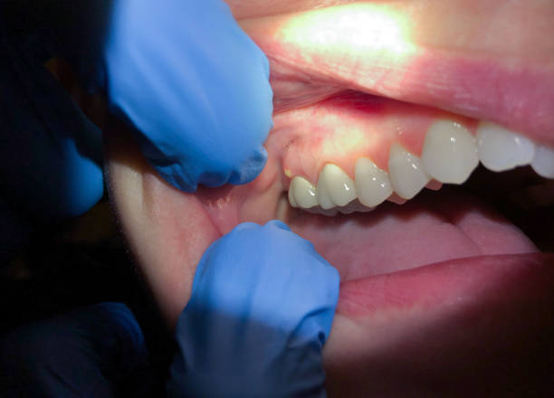 Best Knocked-Out Tooth Emergency  in Demarest, NJ